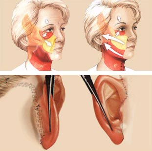Az arcplasztika vágási vonalai, a bőr-, és a bőr alatti struktúrák húzási, rögzítési iránya
