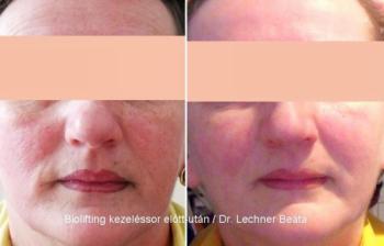 Biolifting arcfiatalítás előtt és a 6. kezelés után/ Dr. Lechner Beáta 